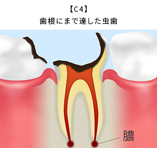 【C4】歯根にまで達した虫歯